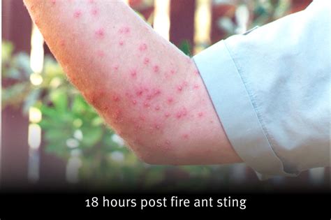 allergic reaction to fire ants icd 10